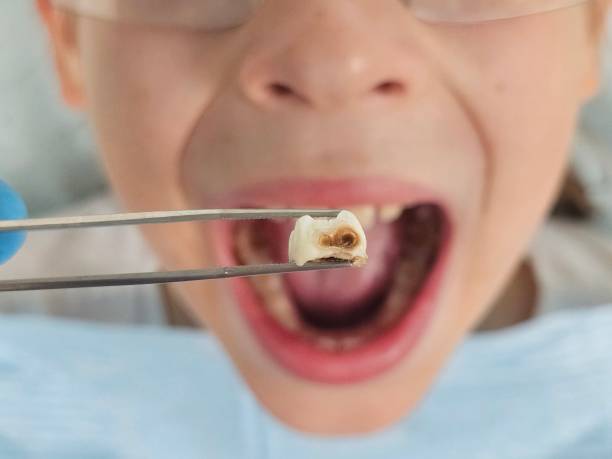 Best Emergency Treatment for Toothache in Commerce, TX